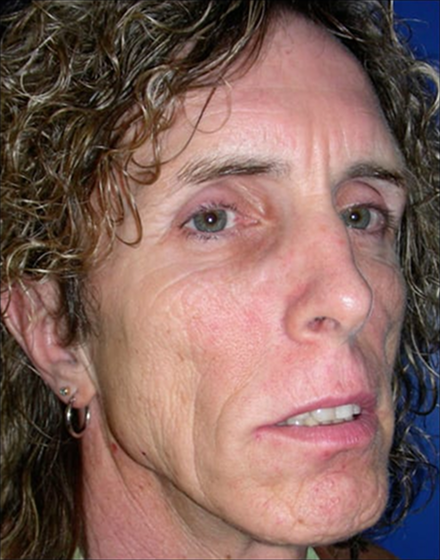 Forehead-type-2-brow-lift-facelift-01 1 before