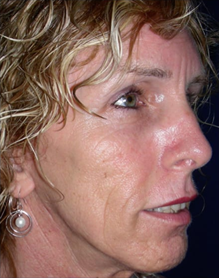 Forehead-type-2-brow-lift-facelift-01 2 after