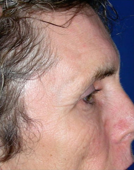 Forehead-type-2-brow-lift-facelift-02 1 before