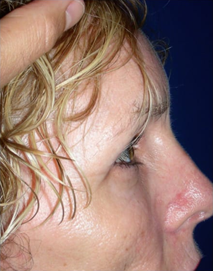 Forehead-type-2-brow-lift-facelift-02 2 after