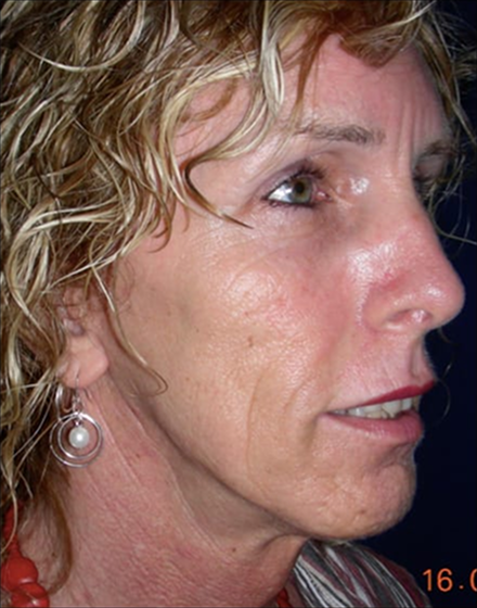 Forehead-type-2-brow-lift-facelift-03-after