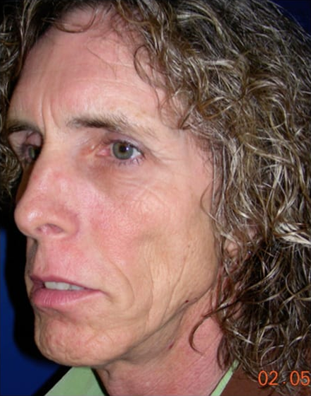Forehead-type-2-brow-lift-facelift-03-before