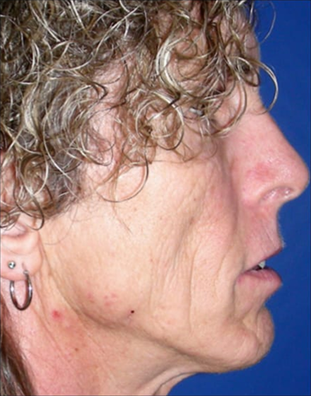 Forehead-type-2-brow-lift-facelift-04-before