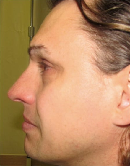 Forehead-type-2-brow-lift-orbital-recontouring 1-before