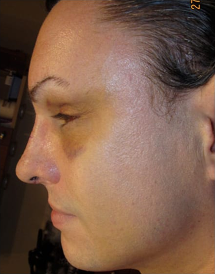 Forehead-type-2-brow-lift-orbital-recontouring 2