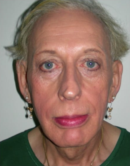 Forehead-type-2-brow-lift-orbital-recontouring-4-eyelids-blepharoplasty-cheek-implants-open-rhinoplasty-lip-fat-graft-01-before