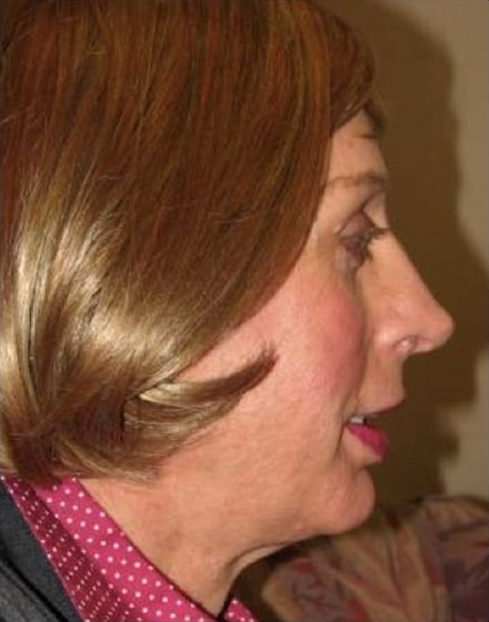 Forehead-type-2-brow-lift-orbital-recontouring-4-eyelids-blepharoplasty-cheek-implants-open-rhinoplasty-lip-fat-graft-02-after