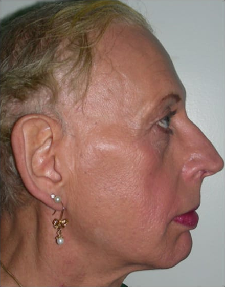 Forehead-type-2-brow-lift-orbital-recontouring-4-eyelids-blepharoplasty-cheek-implants-open-rhinoplasty-lip-fat-graft-02-before