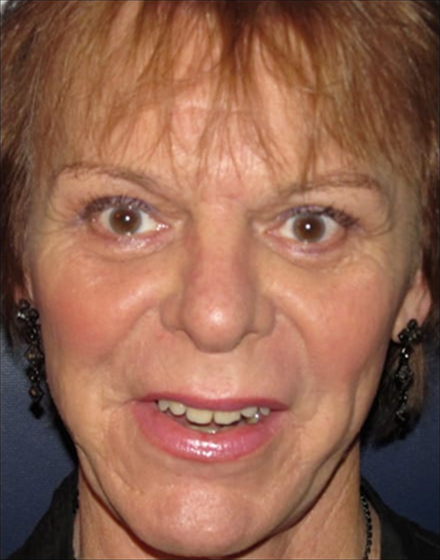 Forehead-type-2-brow-lift-upper-and-lower-blepharoplasty-01-after