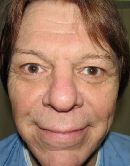 Forehead-type-2-brow-lift-upper-and-lower-blepharoplasty-01-before