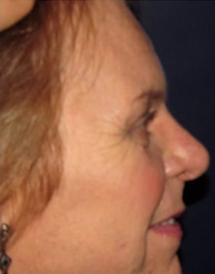 Forehead-type-2-brow-lift-upper-and-lower-blepharoplasty-02-after