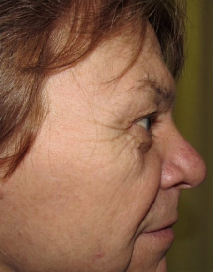 Forehead-type-2-brow-lift-upper-and-lower-blepharoplasty-02-before