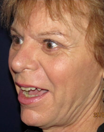 Forehead-type-2-brow-lift-upper-and-lower-blepharoplasty-03 2 (1)