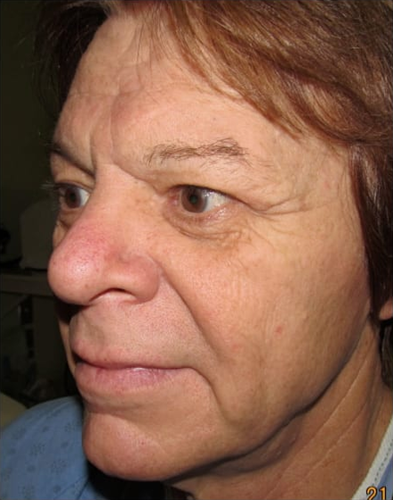 Forehead-type-2-brow-lift-upper-and-lower-blepharoplasty-03-before