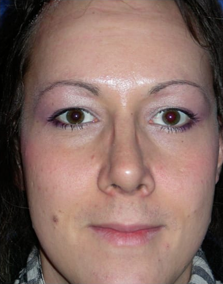 Forehead-type-2-browlift-orbital-recontouring-open-rhinoplasty-01-befoe (1)