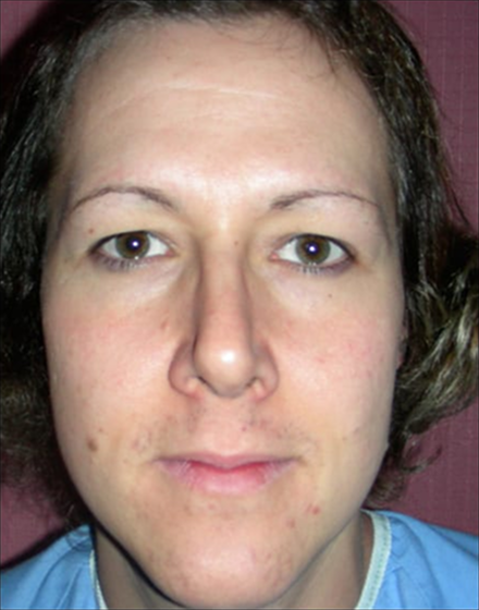 Forehead-type-2-browlift-orbital-recontouring-open-rhinoplasty-01-befoe