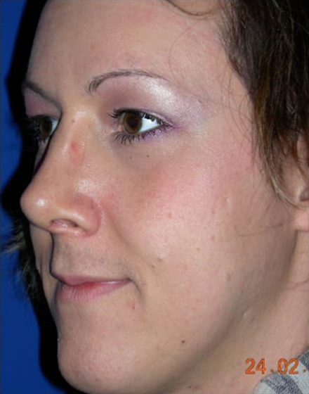 Forehead-type-2-browlift-orbital-recontouring-open-rhinoplasty-02-after