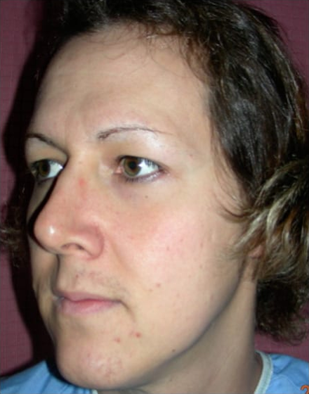 Forehead-type-2-browlift-orbital-recontouring-open-rhinoplasty-02-before