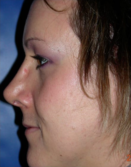 Forehead-type-2-browlift-orbital-recontouring-open-rhinoplasty-03-after