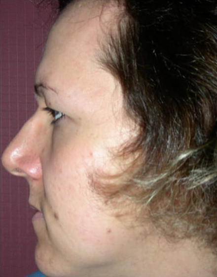 Forehead-type-2-browlift-orbital-recontouring-open-rhinoplasty-03-before