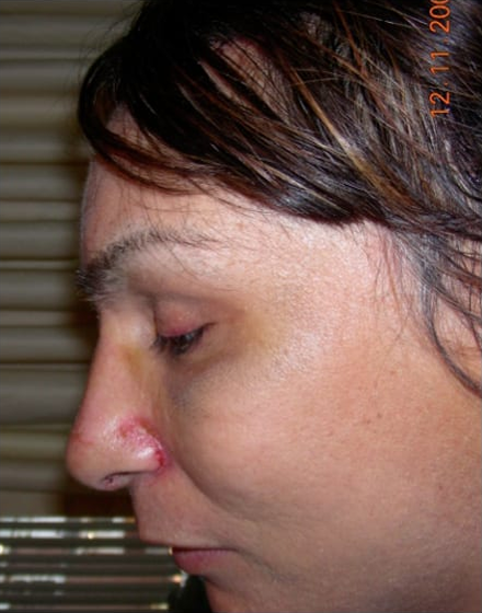 Forehead-type-3-orbital-recontouring-after