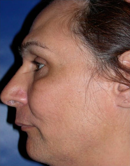 Forehead-type-3-orbital-recontouring-before