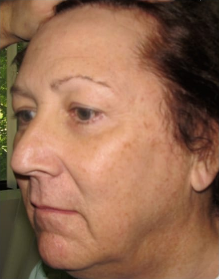 forehead-2-brow-lift 1 before