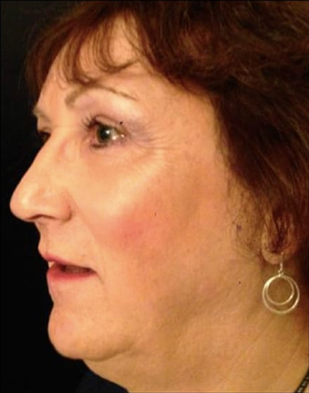 forehead-2-brow-lift 2 after