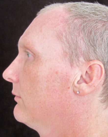 forehead-type-3-browlift-orbital-rim-recontouring-open-rhinoplasty-01-after