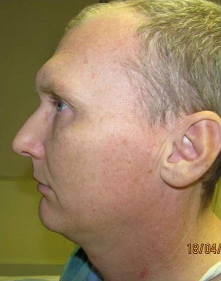 forehead-type-3-browlift-orbital-rim-recontouring-open-rhinoplasty-01-before