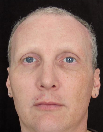 forehead-type-3-browlift-orbital-rim-recontouring-open-rhinoplasty-02-before (1)