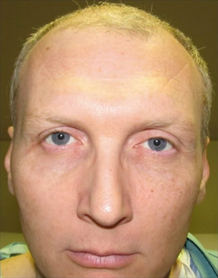 forehead-type-3-browlift-orbital-rim-recontouring-open-rhinoplasty-02-before