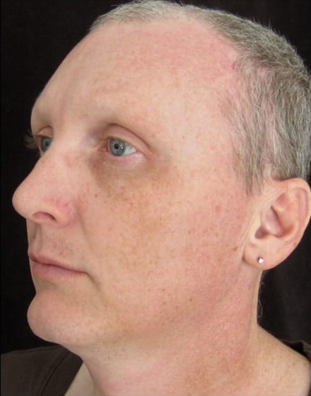 forehead-type-3-browlift-orbital-rim-recontouring-open-rhinoplasty-03-after