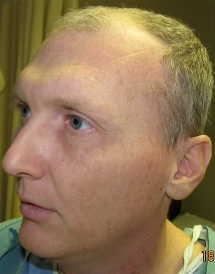 forehead-type-3-browlift-orbital-rim-recontouring-open-rhinoplasty-03-before
